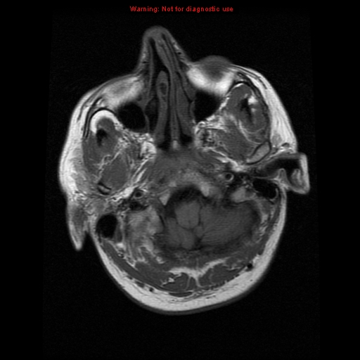 File:Atypical meningioma - grade II (Radiopaedia 13303-13305 Axial T1 3).jpg
