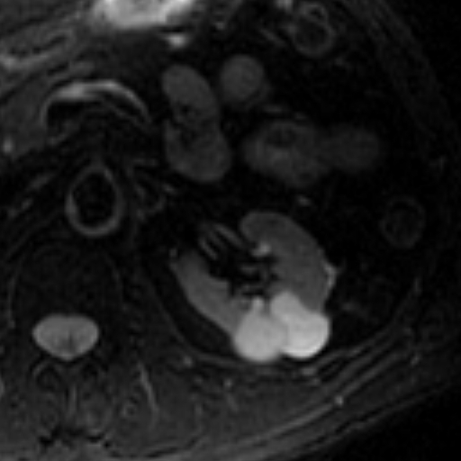 File:Atypical renal cyst on MRI (Radiopaedia 17349-17046 Axial T2 fat sat 10).jpg
