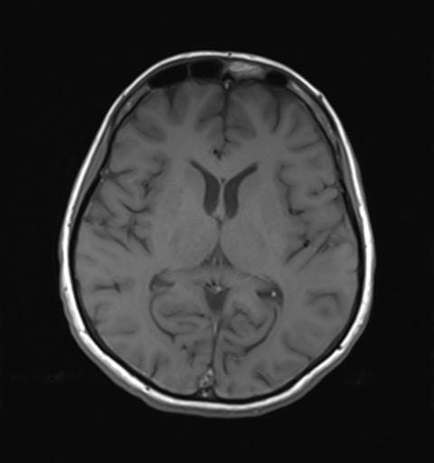File:Autoimmune limbic encephalitis (Radiopaedia 30363-31005 Axial T1 18).jpg