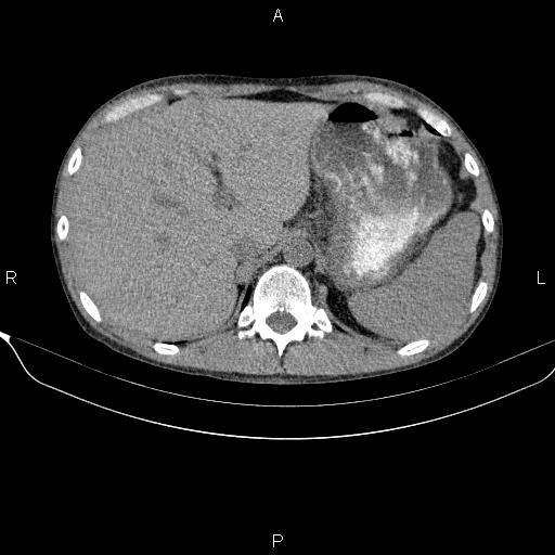 Autoimmune pancreatitis (Radiopaedia 84925-100431 Axial non-contrast 15).jpg
