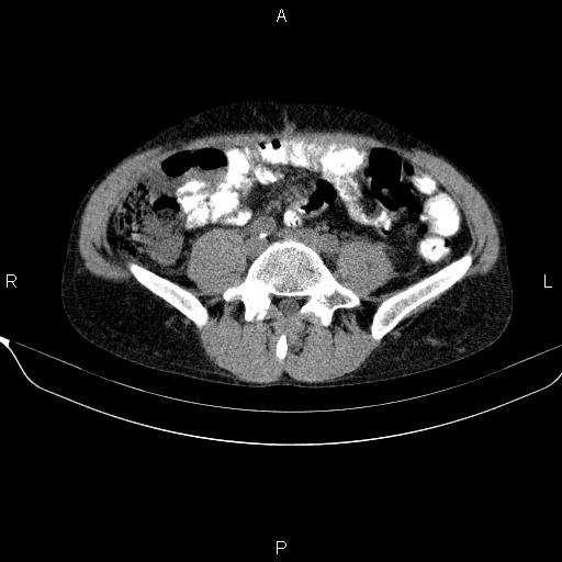 File:Autoimmune pancreatitis (Radiopaedia 84925-100431 Axial non-contrast 36).jpg