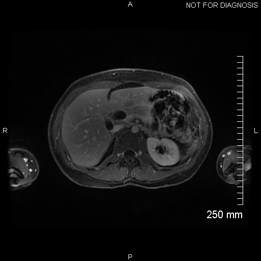 File:Autoimmune pancreatitis (Radiopaedia 88443-105101 A 59).jpg