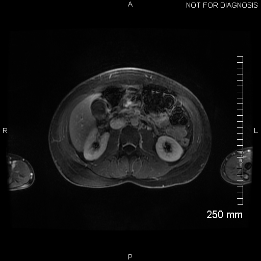 Autoimmune pancreatitis (Radiopaedia 88443-105101 A 82).jpg