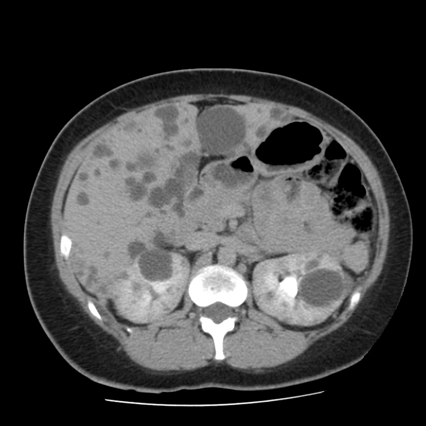 Autosomal dominant polycystic kidney disease (Radiopaedia 23061-23093 C+ delayed 24).jpg