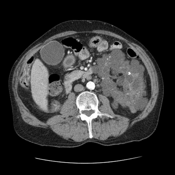 Autosomal dominant polycystic kidney disease (Radiopaedia 27851-28094 B 76).jpg