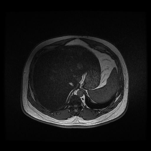 Autosomal dominant polycystic kidney disease (Radiopaedia 50259-55611 Axial 2D Dual Echo 23).jpg