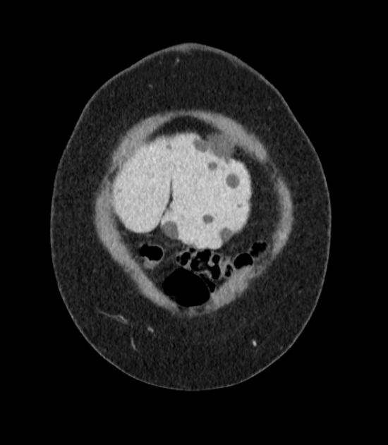 Autosomal dominant polycystic kidney disease (Radiopaedia 57124-64017 B 3).jpg
