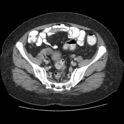 File:Autosomal dominant polycystic kidney disease with hepatic involvement (Radiopaedia 32693-33662 B 64).jpg
