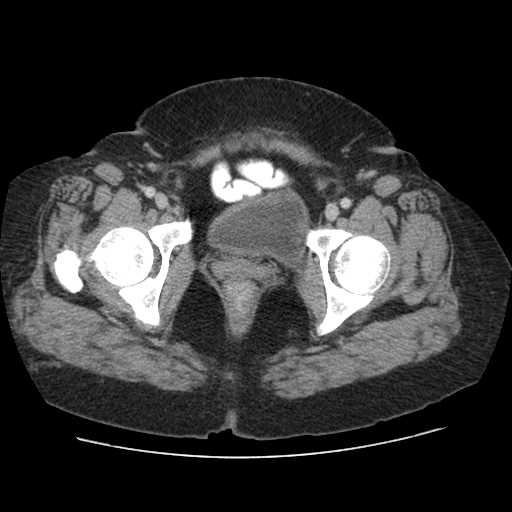 Autosomal dominant polycystic kidney disease with hepatic involvement (Radiopaedia 32693-33662 B 79).jpg