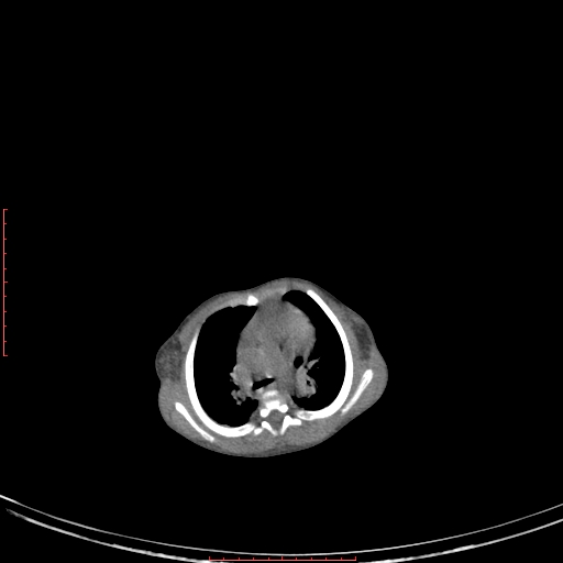 Autosomal recessive polycystic kidney disease associated with Caroli disease (Radiopaedia 61932-69984 B 42).jpg