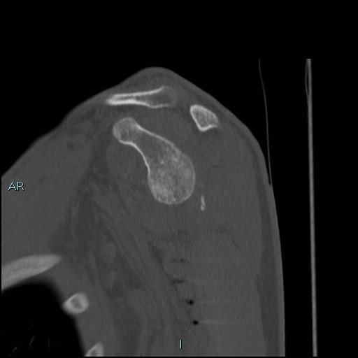 Avascular necrosis after fracture dislocations of the proximal humerus (Radiopaedia 88078-104653 Sagittal bone window 36).jpg