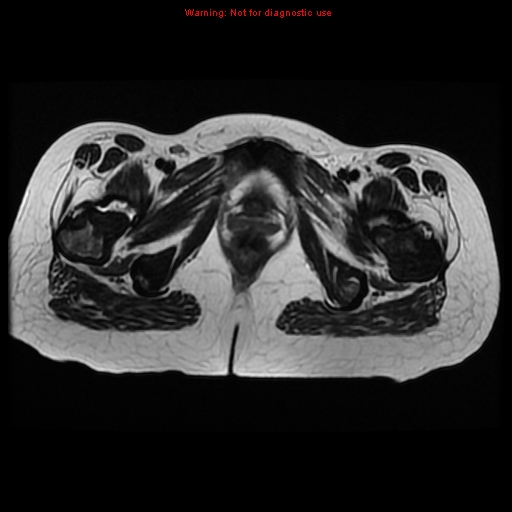 File:Avascular necrosis in sickle cell disease (Radiopaedia 17448-17151 Axial T2 13).jpg