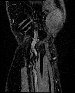 Avascular necrosis of the capitate (Radiopaedia 88317-104948 Coronal T1 vibe 85).jpg