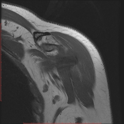 File:Avulsion fracture - greater tuberosity of humerus (Radiopaedia 25457-25703 Coronal T1 2).jpg