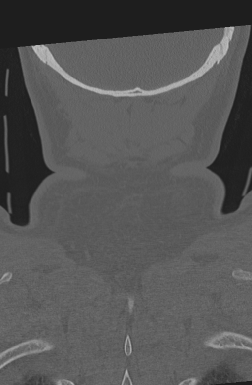 Axis peg fracture (type 3) and atlas lateral mass (type 4) fracture (Radiopaedia 37474-39324 Coronal bone window 63).png