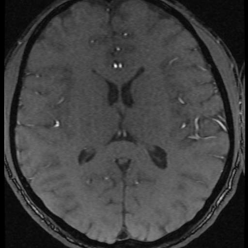 File:Azygos anterior cerebral artery (Radiopaedia 17059-16756 Axial MRA 1).jpg