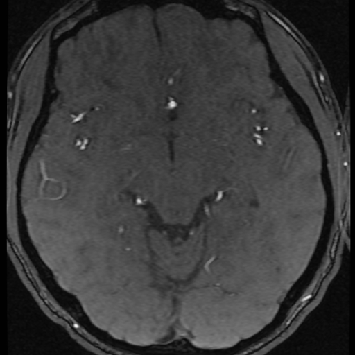 File:Azygos anterior cerebral artery (Radiopaedia 17059-16756 Axial MRA 32).jpg