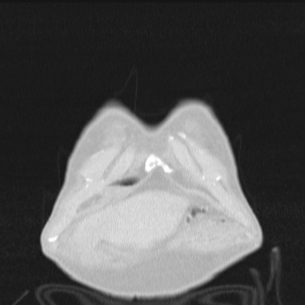 Azygos lobe (Radiopaedia 38259-40275 Coronal lung window 6).jpg