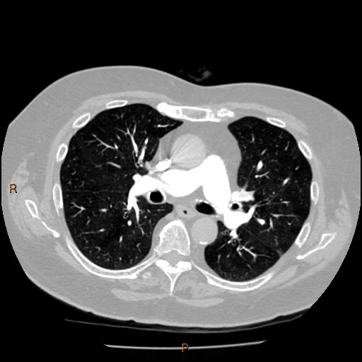 Azygos lobe (Radiopaedia 40161-42821 Axial lung window 31).jpg