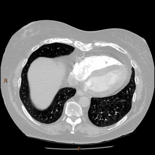 Azygos lobe (Radiopaedia 40161-42821 Axial lung window 55).jpg