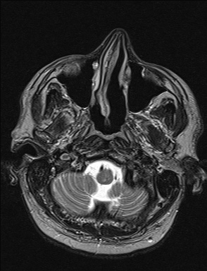 File:Balo concentric sclerosis (Radiopaedia 50458-55940 Axial T2 40).jpg