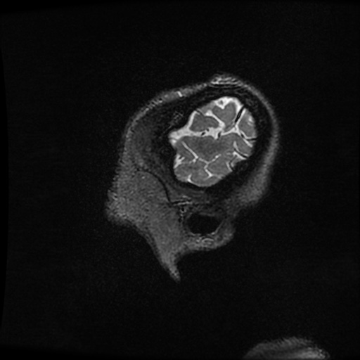 Balo concentric sclerosis (Radiopaedia 53875-59982 Sagittal 3D FSE 12).jpg