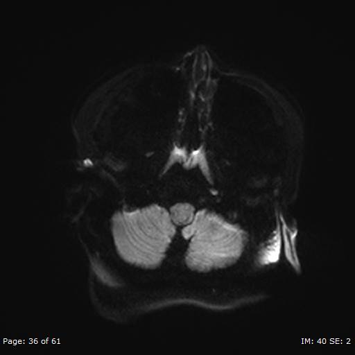 Balo concentric sclerosis (Radiopaedia 61637-69636 Axial DWI 36).jpg
