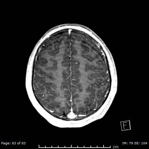 Balo concentric sclerosis (Radiopaedia 61637-69636 Axial T1 C+ 63).jpg