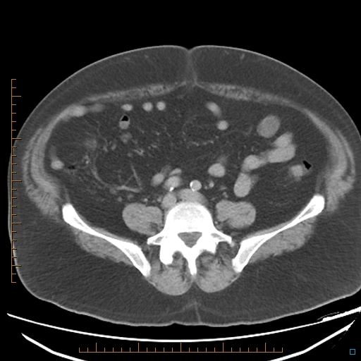 File:Bariatric balloon causing gastric outlet obstruction (Radiopaedia 54449-60672 A 28).jpg
