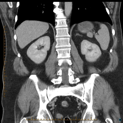 File:Bariatric balloon causing gastric outlet obstruction (Radiopaedia 54449-60672 B 42).jpg