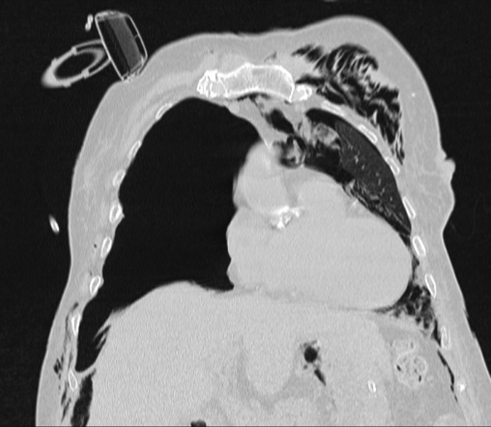 Barotrauma due to mechanical ventilation (Radiopaedia 28079-28336 Coronal lung window 34).jpg