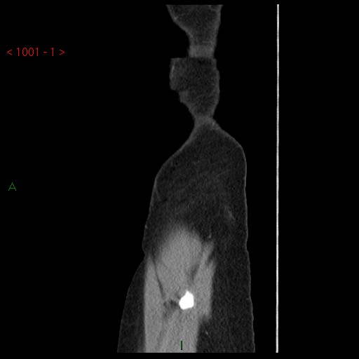 File:Bartholin gland cyst (Radiopaedia 54904-61181 Sagittal C+ delayed 1).jpg