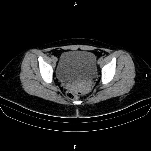 Bartholin gland cyst (Radiopaedia 62635-70930 Axial non-contrast 55).jpg