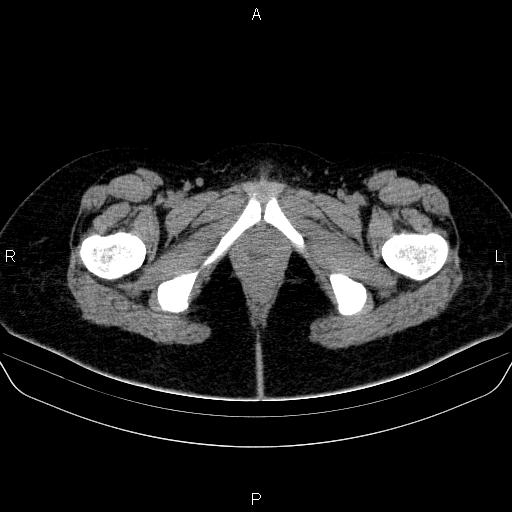 Bartholin gland cyst (Radiopaedia 62635-70930 Axial non-contrast 88).jpg