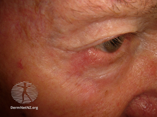 File:Basal cell carcinoma affecting the face (DermNet NZ lesions-bcc-face-0824).jpg