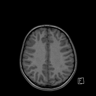 Base of skull rhabdomyosarcoma (Radiopaedia 32196-33142 Axial T1 36).jpg