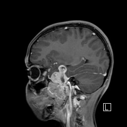 Base of skull rhabdomyosarcoma (Radiopaedia 32196-33142 J 22).jpg