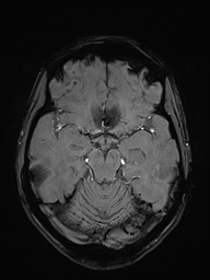 Basilar artery perforator aneurysm (Radiopaedia 82455-97733 Axial SWI 21).jpg