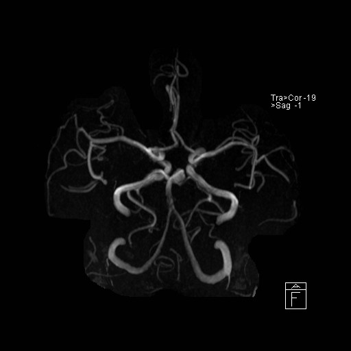 Basilar tip aneurysm (Radiopaedia 26504-26632 D 7).jpg