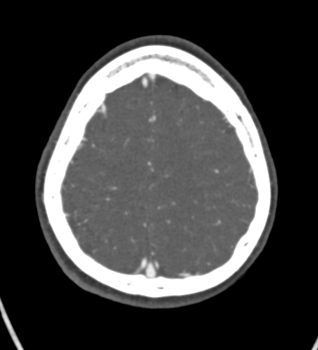 Basilar tip aneurysm with coiling (Radiopaedia 53912-60086 A 122).jpg