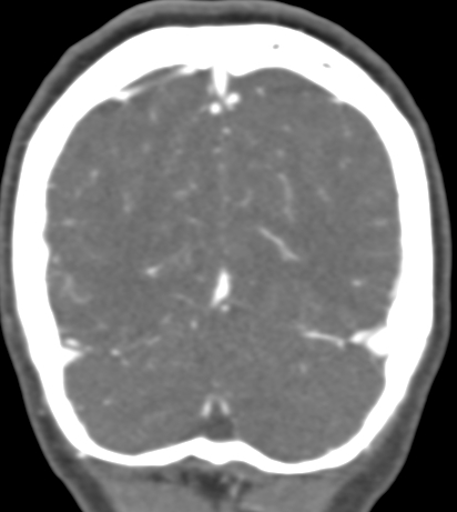 Basilar tip aneurysm with coiling (Radiopaedia 53912-60086 B 132).jpg