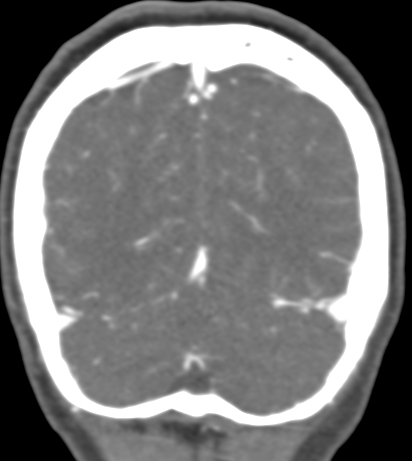 Basilar tip aneurysm with coiling (Radiopaedia 53912-60086 B 133).jpg