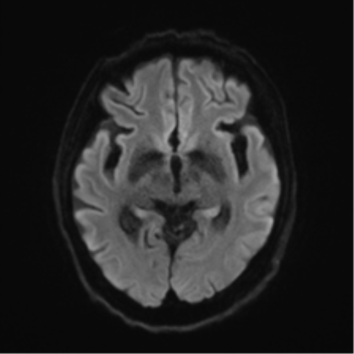 Behavioral variant frontotemporal dementia and late onset schizophrenia (Radiopaedia 52197-58083 Axial DTI Trace W 39).png
