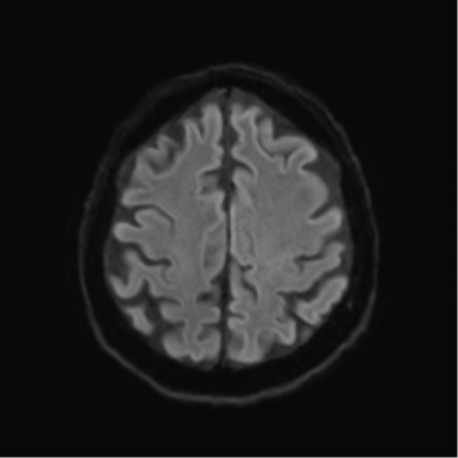 Behavioral variant frontotemporal dementia and late onset schizophrenia (Radiopaedia 52197-58083 Axial DTI Trace W 47).png