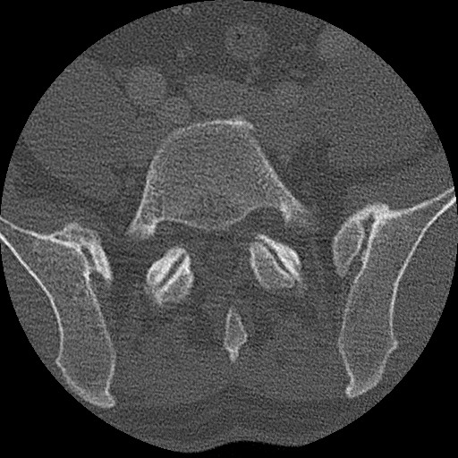 Benign post-traumatic pseudopneumoperitoneum (Radiopaedia 71199-81495 Axial bone window 277).jpg