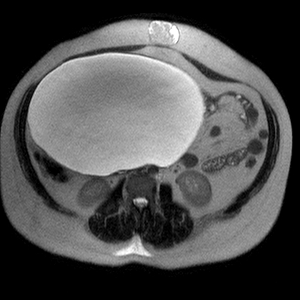 File:Benign seromucinous cystadenoma of the ovary (Radiopaedia 71065-81300 Axial T2 5).jpg