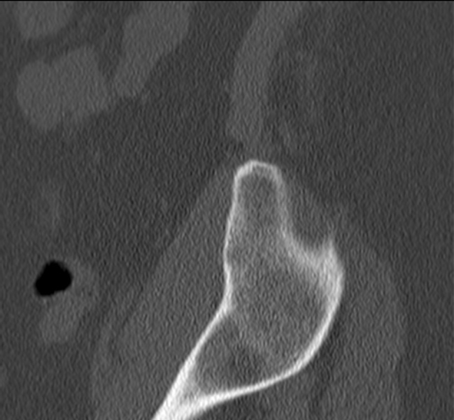 Bertolotti syndrome (Radiopaedia 24864-25128 Sagittal bone window 58).jpg