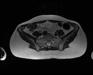 File:Bicornuate bicollis uterus (Radiopaedia 61626-69616 Axial T2 3).jpg