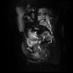 File:Bicornuate uterus (Radiopaedia 51676-57472 Sagittal DWI 14).jpg