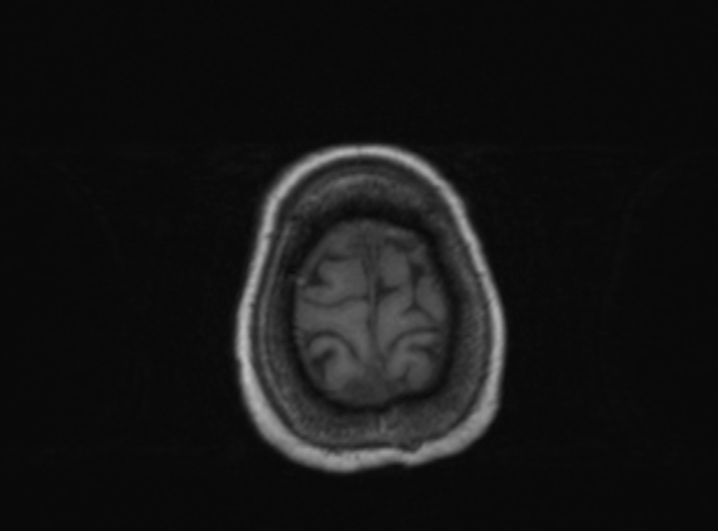 Bilateral PCA territory infarction - different ages (Radiopaedia 46200-51784 Axial T1 125).jpg
